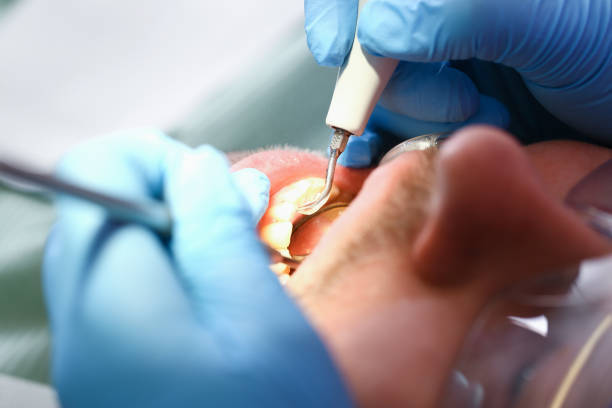 Best Emergency Tooth Extraction in Lake City, IA